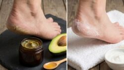 Quick Healing Method for Dry Cracked Heels Using Simple Kitchen Ingredients